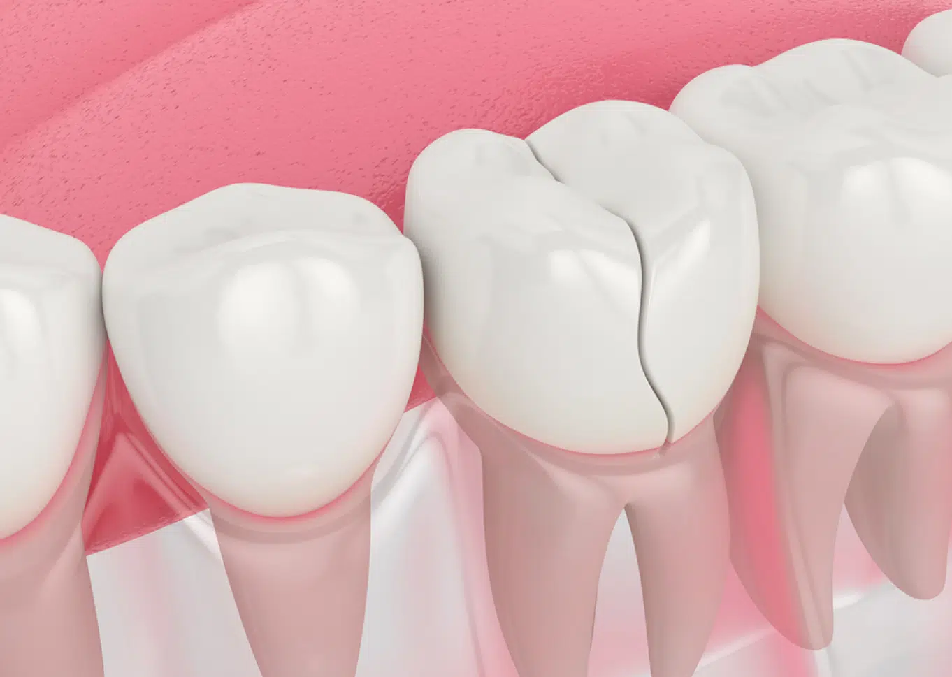 Broken, Chipped, or Cracked Teeth2