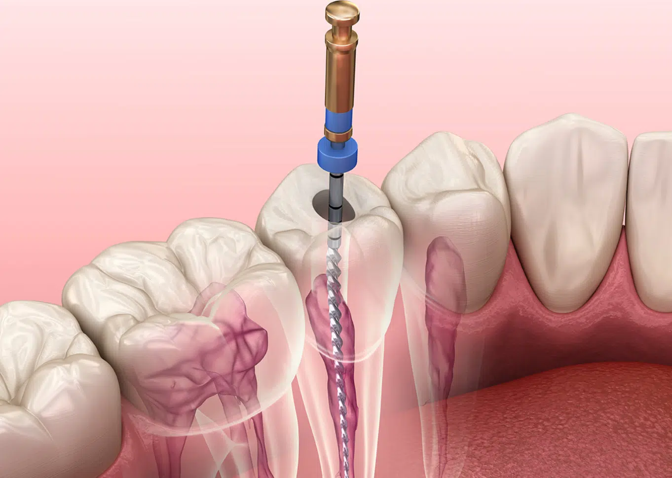 Crowns After a Root Canal2