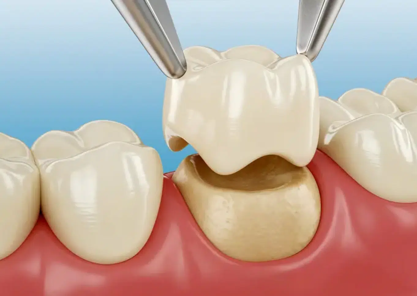 Replacing Old or Failing Crowns2 Tooth-Colored Fillings