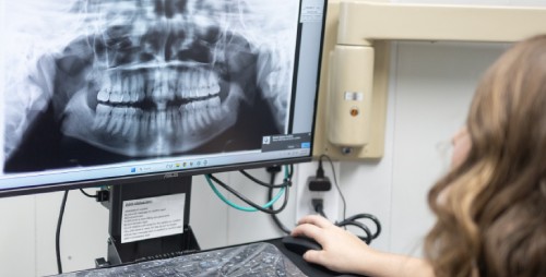 Replacing Old or Failing Crowns (1)