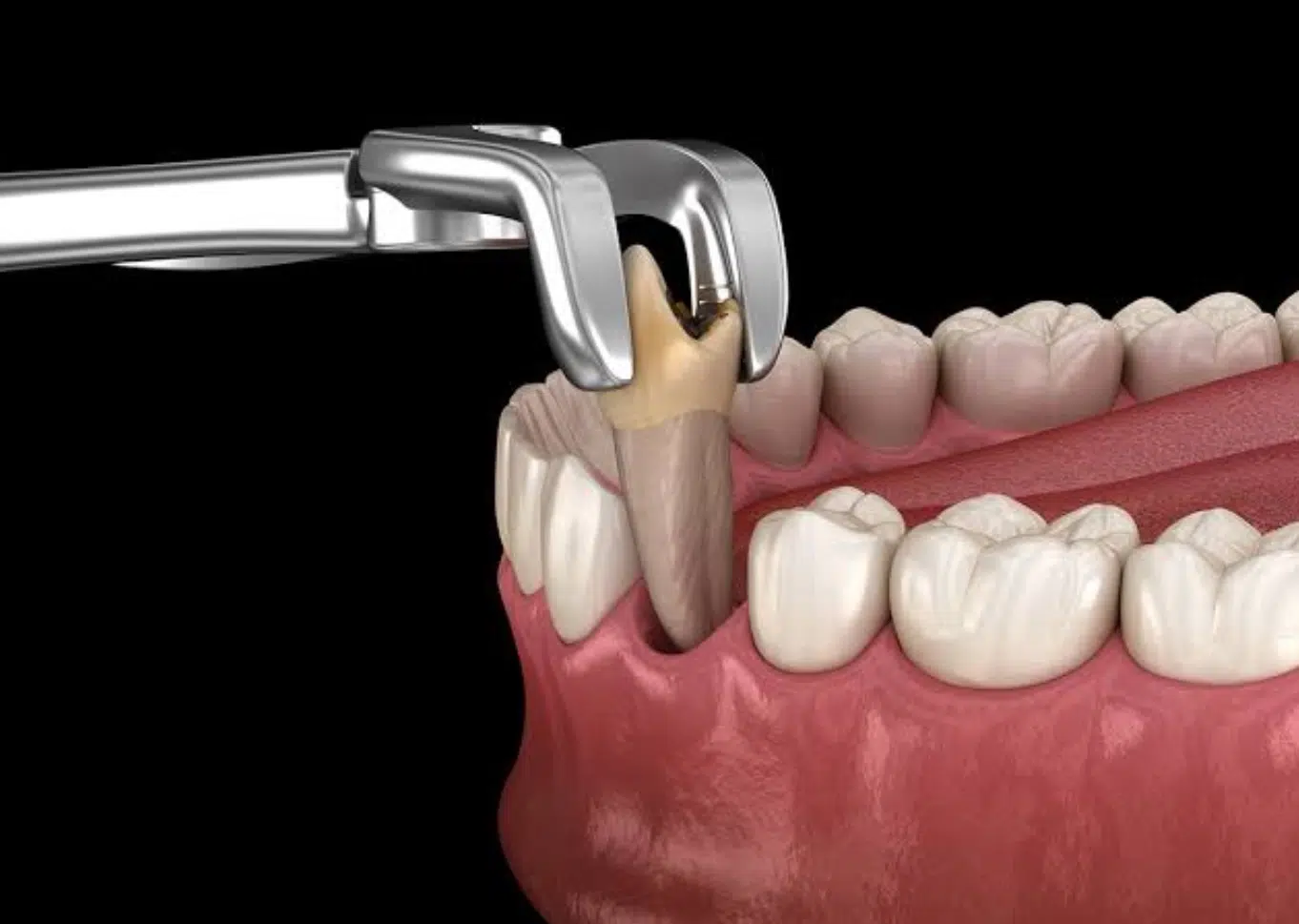 Tooth Extractions2